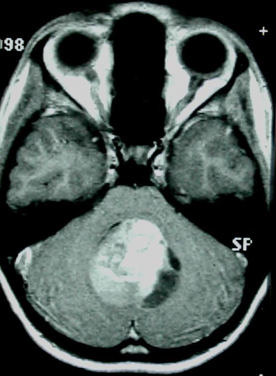 MEULLOBLASTOMA