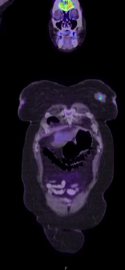 FDG-PET/CT