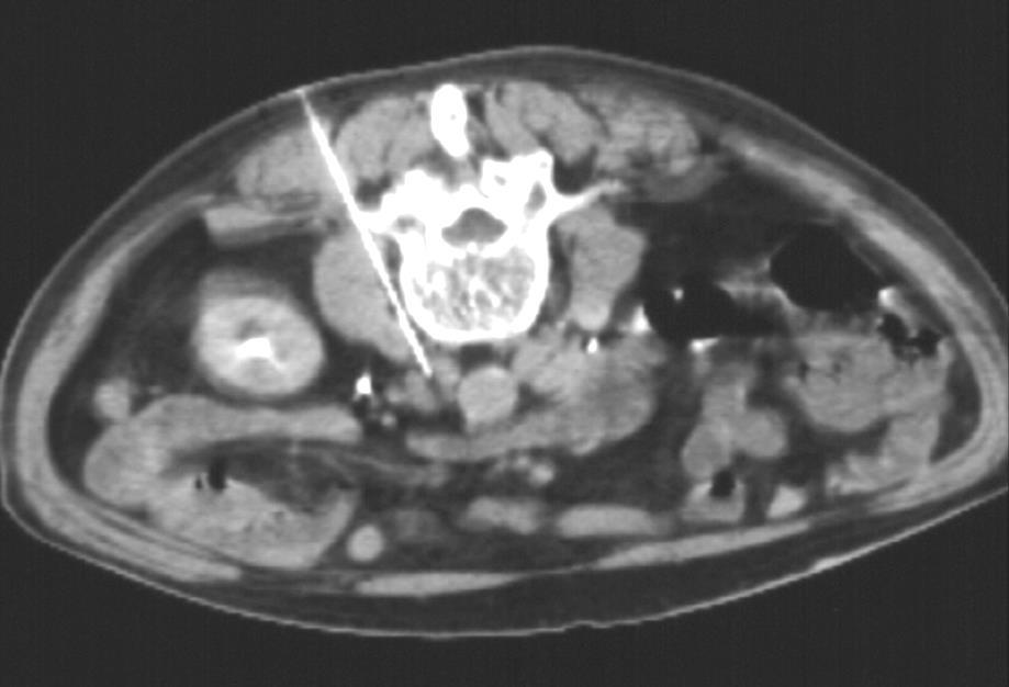 CT vezérelt biopsia