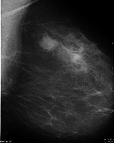 RTG Mammográfia érzékenysége Irodalmi