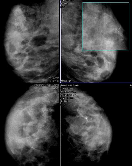 módszere: MAMMOGRAPHY Amennyiben az emlő