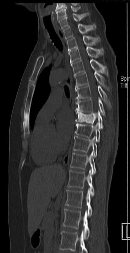 CT PET/CT