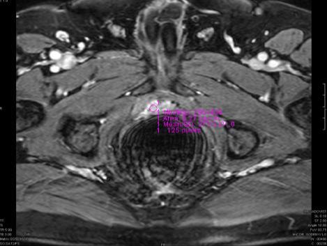 Prosztata ca vizsgálata Szűrés - PSA (prosztata specifikus antigen) TU-ra NEM fajlagos Diagnózis: Transrectalis UH - color Doppler - TRUH- vezérelt biopszia Color Doppler javítja a góc megítélését