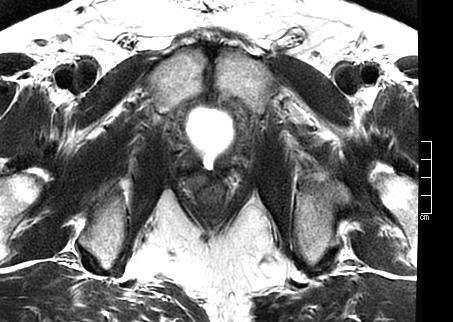 Prosztata carcinoma