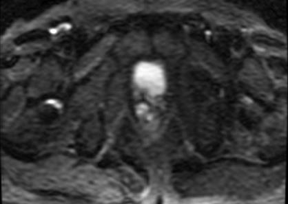 Adenocarcinoma,