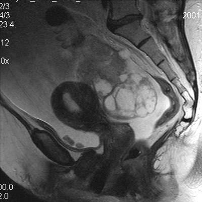 Vezérelt /UH, CT/ biopszia PET/CT metasztázis,