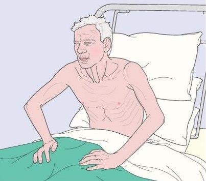 A súlyos COPD klinikai