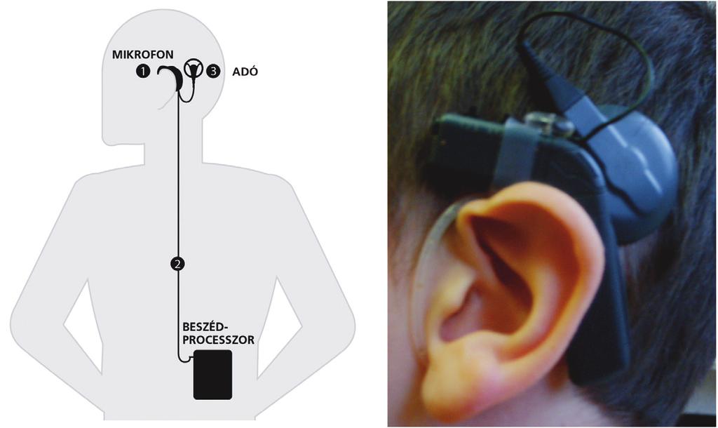 Három. A hallássérültek által használt gyógyászati segédeszközök 10 11 lések kb. 95%-ánál a csiga (cochlea) megbetegedése okozza a hallásproblémát (cochleáris hallássérülés).