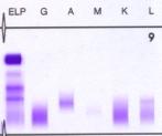 8. ábra: oligoklonális gammopathia: IgG kappa/lambda α-, µ- nehézlánc Megoldandó