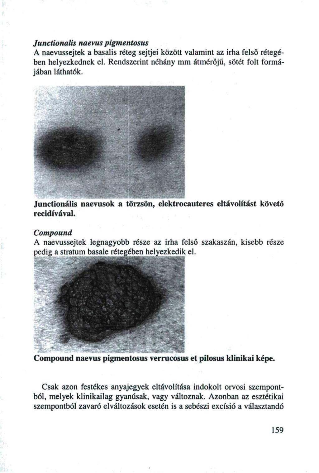 Junctionalis naevus pigmentosus A naevussejtek a basalis réteg sejtjei között valamint az irha felső rétegében helyezkednek el. Rendszerint néhány mm átmérőjű, sötét folt formájában láthatók.
