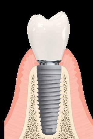 Tanulmány Kezdőprogram 2016. 6. oldal 2 3 A fogászati implantátum bizonyított eredményekkel rendelkezik A fogászati implantátum nem új felfedezés.