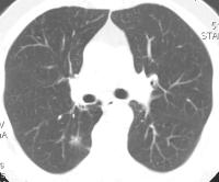 1. ár. Az xiális síkú mellks-ct-vizsgált, tüdô-lkkl megjelenítve kis, lcsony intenzitású gócot árázol jo lsó leenyen hilus mögött, prverterlisn.
