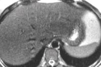 nálhtó (PET-CT). A felvétel mértéke és így z elváltozás kimutthtóság tumor szövettni típusától, méretétôl és ktuális metolikus állpotától függ.