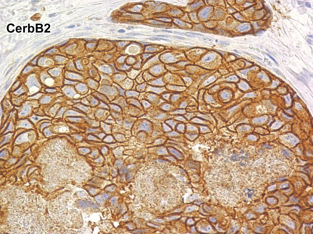 HER-2 expression in breast carcinoma HER2-protein erős kifejeződése