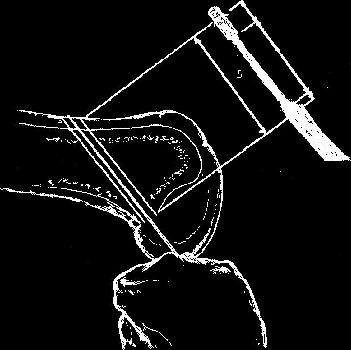 L 1. ábra A femoralis csontcsatorna hossza (L)= horgony+öltés+szalagvég (1 mm) hossza 2.