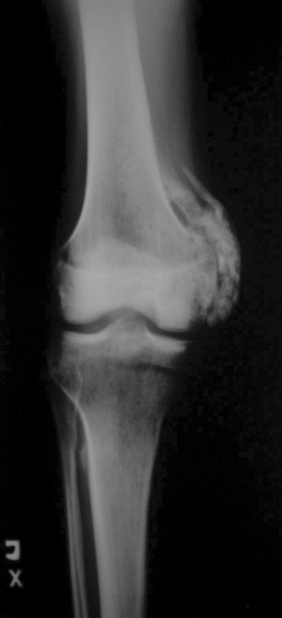 86 OSTEOLOGIAI KÖZLEMÉNYEK 2012/3 A C D B 1. kép. B. J. 47 éves férfi (1.