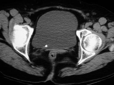 Urolithiasis CT: kis kövek kimutatására is alkalmas => kő keresésére low dose CT napjainkra gold standarddá vált MR: üregrendszeri tágulatot egyértelműen jelzi, követ nem.