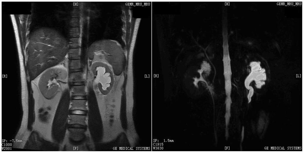 Chronicus obstructio Diagnosztikus sor UH: Chronicus üregrendszeri tágulat (jellegzetes forma - lekerekítettség), kisebb vese, elkeskenyedett parenchyma