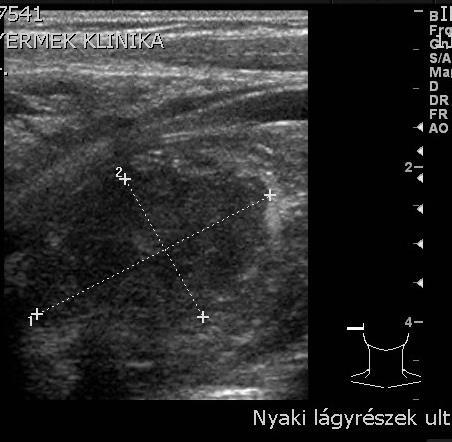 abscessus?