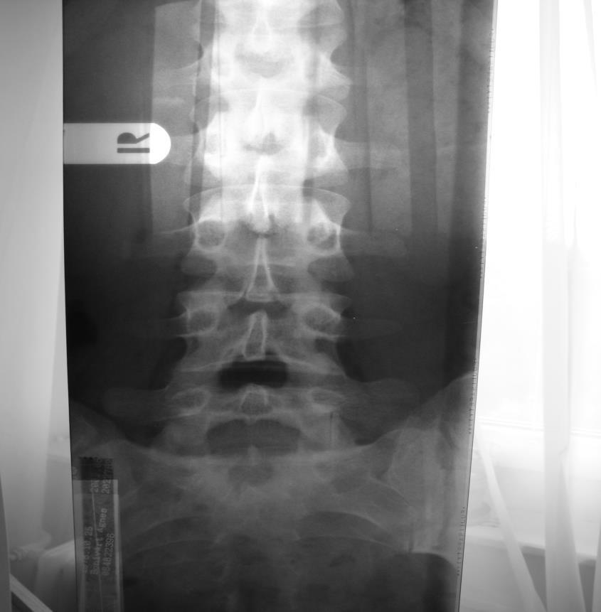 X-ray and