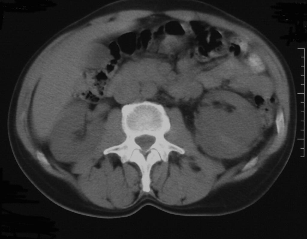 renalis thrombosis, ureter avulsios sérülés ) - minor sérülések 1.kicsi intrarenalis haematoma 2.