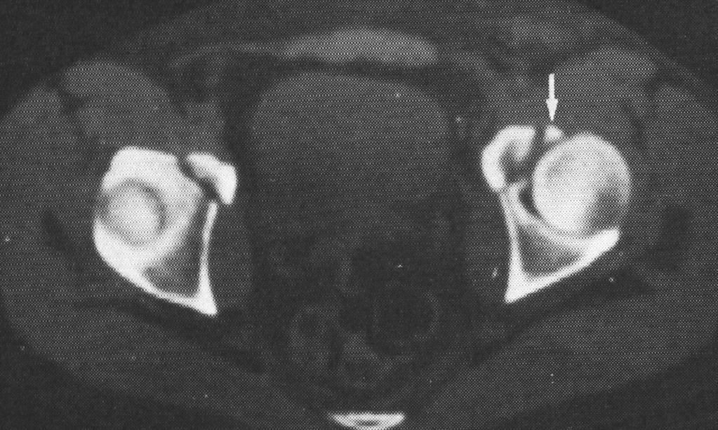 Acetabulum sérülései - perem- pillér- dóm-