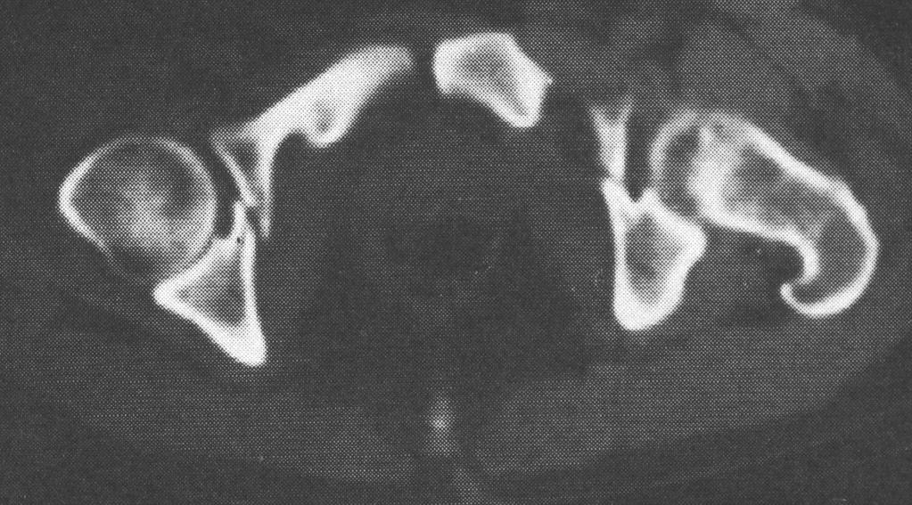 pillértörés: ilioischialis vagy