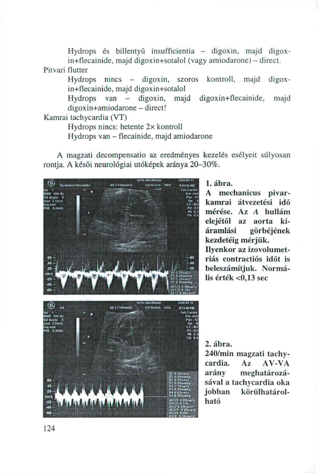 Hydrops és billentyű insufficientia - digoxin, majd digoxin+flecainide, majd digoxin+sotalol (vagy amiodarone) - direct.