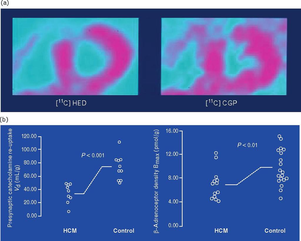 Imaging of myocardial receptors: applications in the evaluation of cardiac disease Heart Metab.