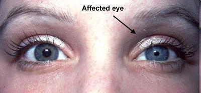 Horner szindróma: Ptosis, Myosis, Enophthalmus Horner syndrome results from damage to the sympathetic nerves of the face.