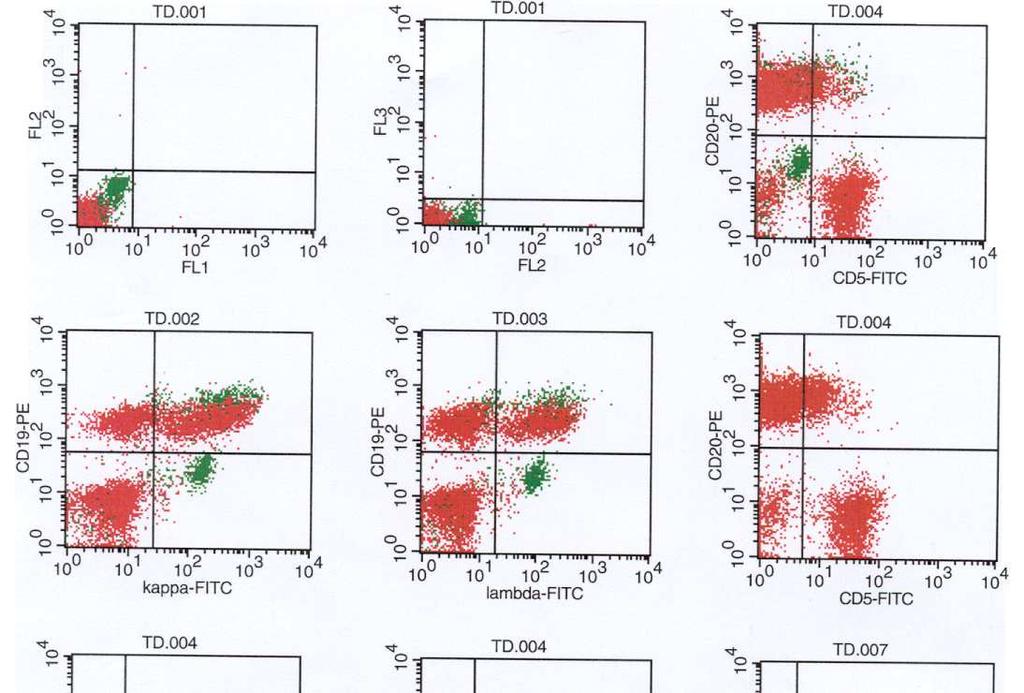 Mononucleosis korai B-sejtes B fázis Lymphocytosis