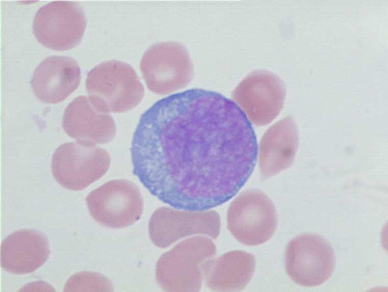 bakteriális infekció Lymphocytás leukaemia Myeloma,