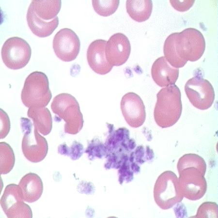 Pseudo-thrombocytopenia EDTA indukálta TCT aggregáció