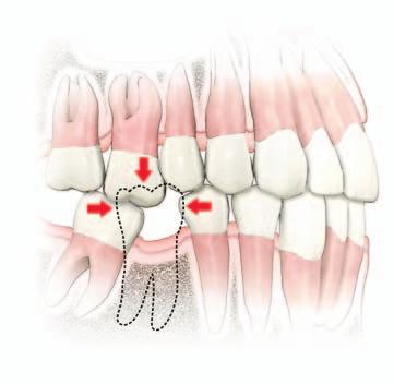 Mi történik, amikor hiányzik egy fog? Az egészséges fognak sok különböző szerepe van a száj hátsó részén. Segíti az ételt probléma nélkül megrágni. továbbá stabilizálja a körülötte lévő fogakat.