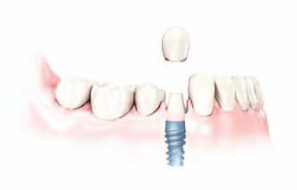 Fogpótlás fogászati implantátumon A fogászati implantátumokat az állcsontba ültetik be, úgy viselkednek, mint a természetes fogak gyökerei.