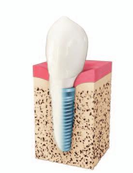 A fogászati implantátumok sok előnnyel rendelkeznek Mi a fogászati implantátum? A fogászati implantátum lesz az új fog gyökere.