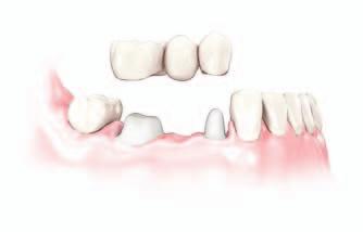 Fogpótlás fogászati implantátumon A fogászati implantátumokat az állcsontba ültetik be, úgy viselkednek, mint a természetes fogak gyökerei.