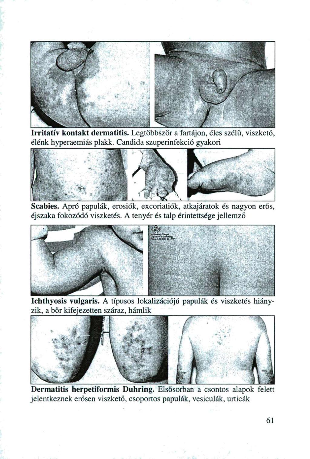 Irritatív kontakt dermatitis. Legtöbbször a fartájon, éles szélű, viszkető, élénk hyperaemiás plakk. Candida szuperinfekció gyakori Scabies.