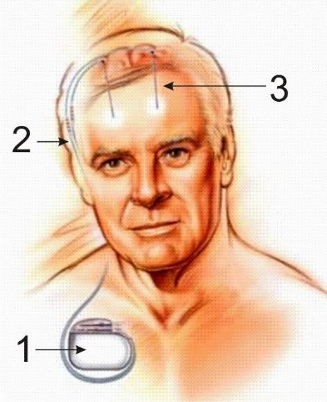 3.3.3. A mély agyi stimulátor szerkezeti felépítése A stimulációs rendszer alapvetően három részből áll (3.5. ábra): Elektróda.