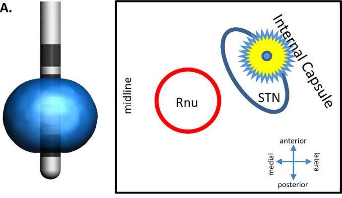 Amennyiben ez az elektróda szuboptimális elhelyezkedésű, úgy a környező struktúrákra is könnyedén ráterjedhet a stimuláció, ami mellékhatásokat is okozhat (A ábra, a capsula internára
