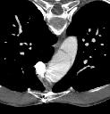 haematoma nativ CT