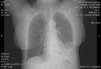 Mellüregi folyadékgyülem (hydrothorax) Folyadék