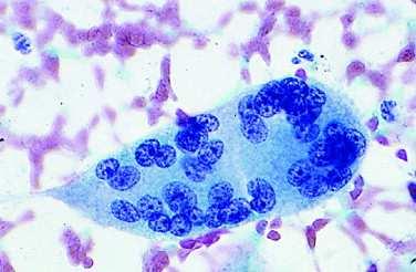 Trophoblast sejtek :Syncytiotrophoblast könnyen felismerhető