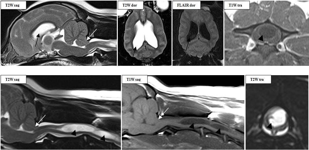 11. ábra Occipitalis hypo-/dysplasia következtében kialakult cerebellaris herniatio (fehér nyíl), generalizált agykamratágulat (fekete nyíl) és syringomyelia (nyílhegy) Chiari malformatio.