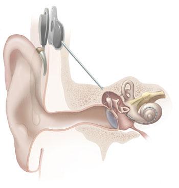 Zajok konstruktív szerepben Sztochasztikus rezonancia Cochlea-implantátumok Cochlea-beültetés: a külső mikrofon jelét a jelföldolgozó egység elektromos impulzusokká alakítja,