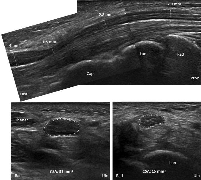 4. ábra. Carpalis alagút syndroma körülírt distalis kompresszióval. Felső kép: hosszmetszet. Alsó képek: keresztmetszet (jobb- alagút bejárata, bal- kijárata).