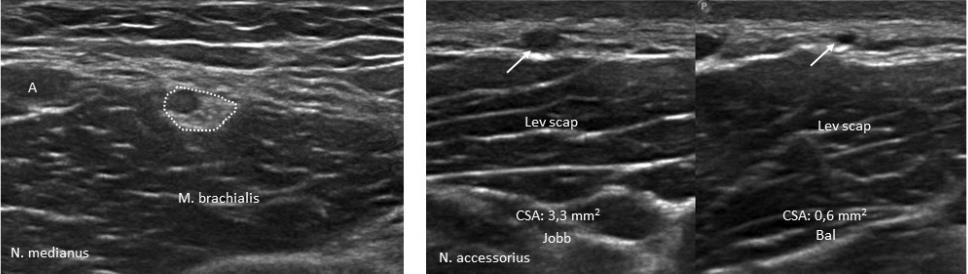 8. ábra. Segmentalis megnagyobbodás / fascicularis érintettség. Bal oldali kép: n. medianus a felkaron, egy nagy hypoechogén fasciculussal AIN laesióval társulva (szaggatott vonal).