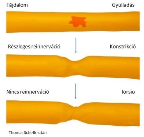 kimenetel, a reinnerváció elmaradása között statisztikailag szignifikáns összefüggés mutatkozott. Öt idegnél az általunk fascicularis összefonódásnak nevezett jelenséget is észleltünk.