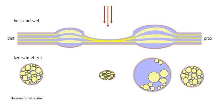 2. ábra. Az idegkompresszió neurosonographiai jelei sematikusan (felső kép) és carpalis alagút syndromában (alsó kép).