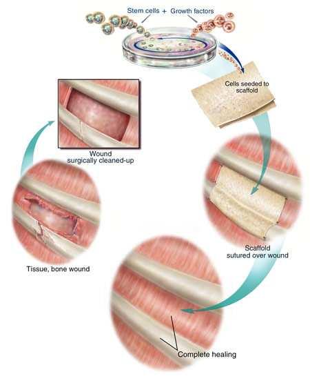 Tissue engineering Definíció: olyan regeneratív gyógyászat, aminek célja a beteg saját őssejtjeinek differenciáltatása és tenyésztése egy vázanyagon (scaffold) amit aztán a betegbe ültetnek.